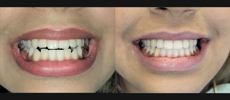 Ceramic braces 20 months