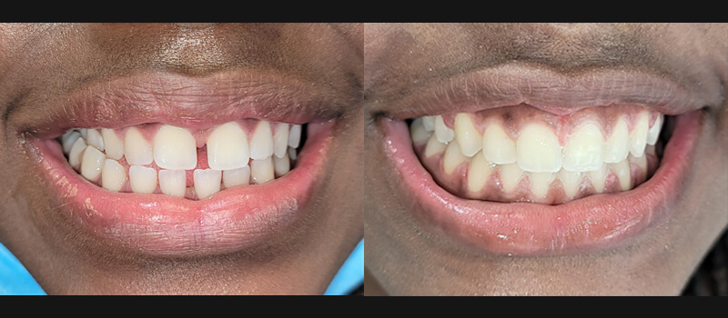 Invisalign 16 months