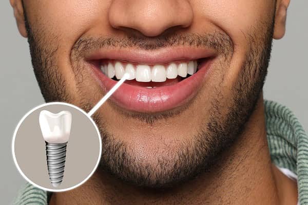 Dental Implants in Oakville