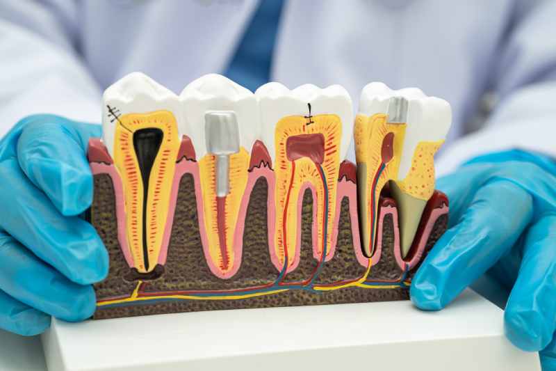 A dentist in blue gloves holds a model illustrating various stages of tooth decay and dental treatments, including where a dental implant would be placed.