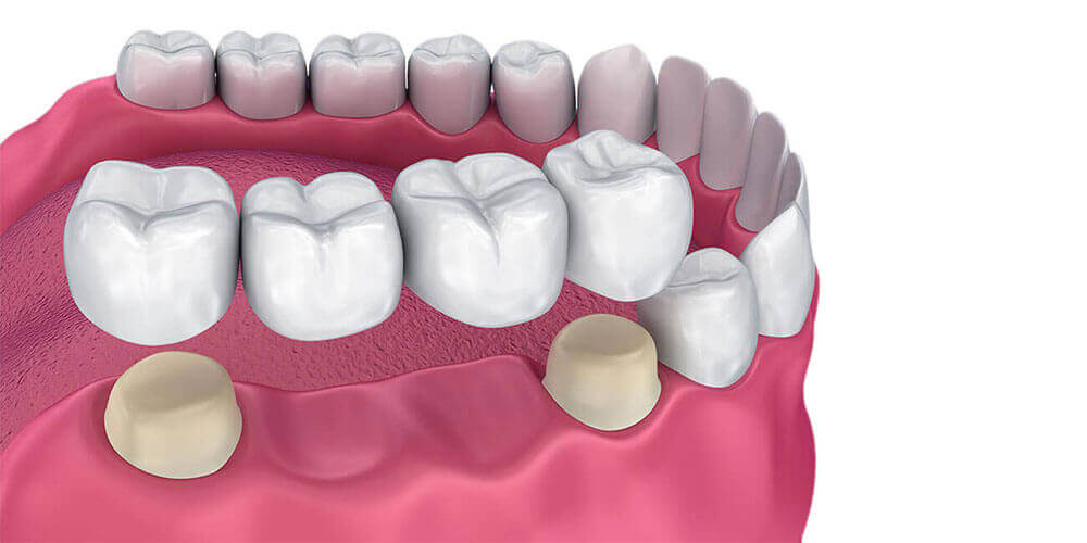 Dental Bridges Oakville