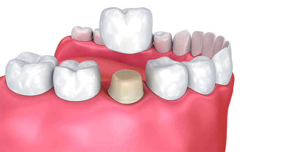 Dental Crowns Oakville