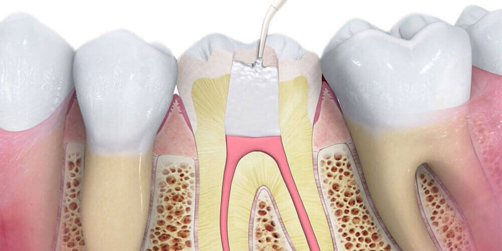 Root Canal Treatment Oakville