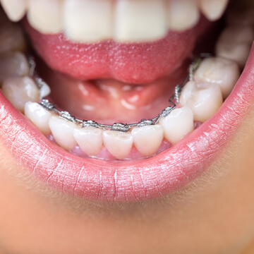 Lingual braces