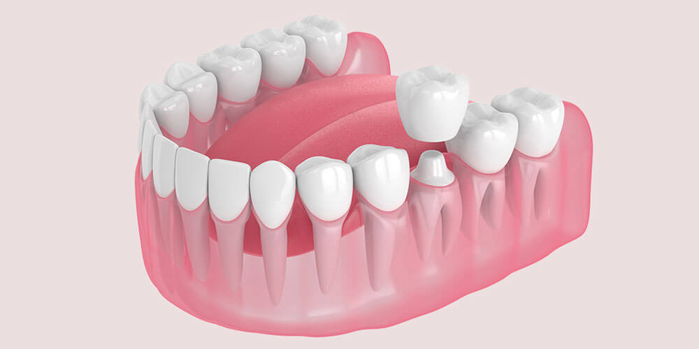 How Dental Crowns Enhance Your Smile and Oral Health