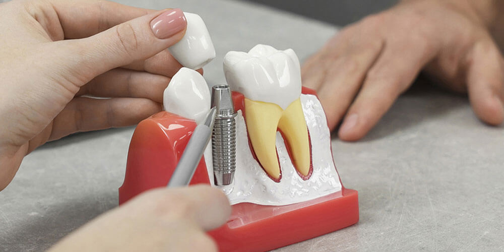 The Benefits of Getting Dental Implants for Missing Teeth