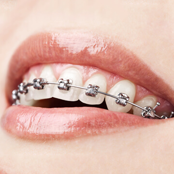 Self-ligating braces